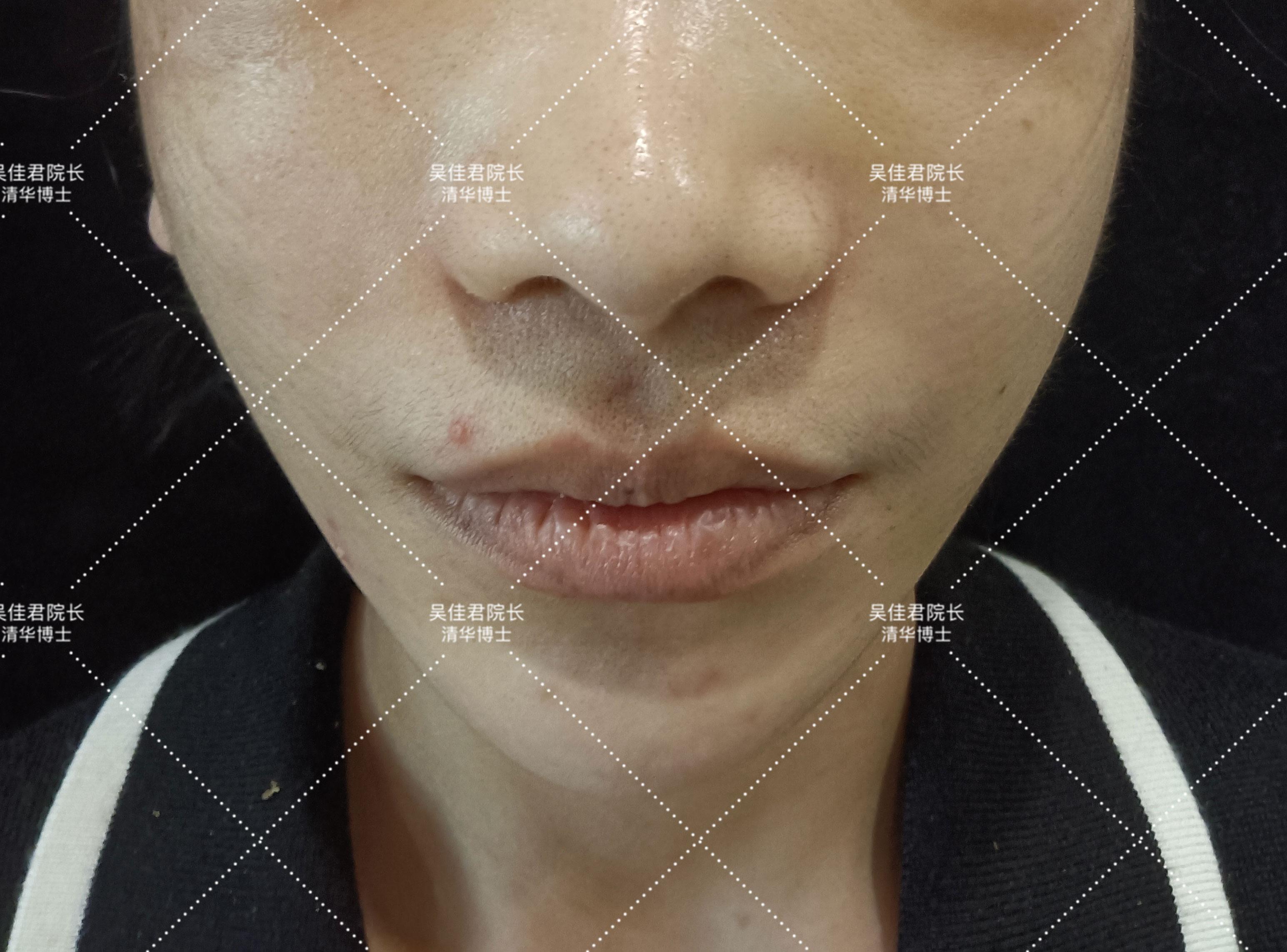 最新小拉皮手術(shù)方法，重塑自信，成就美麗之源