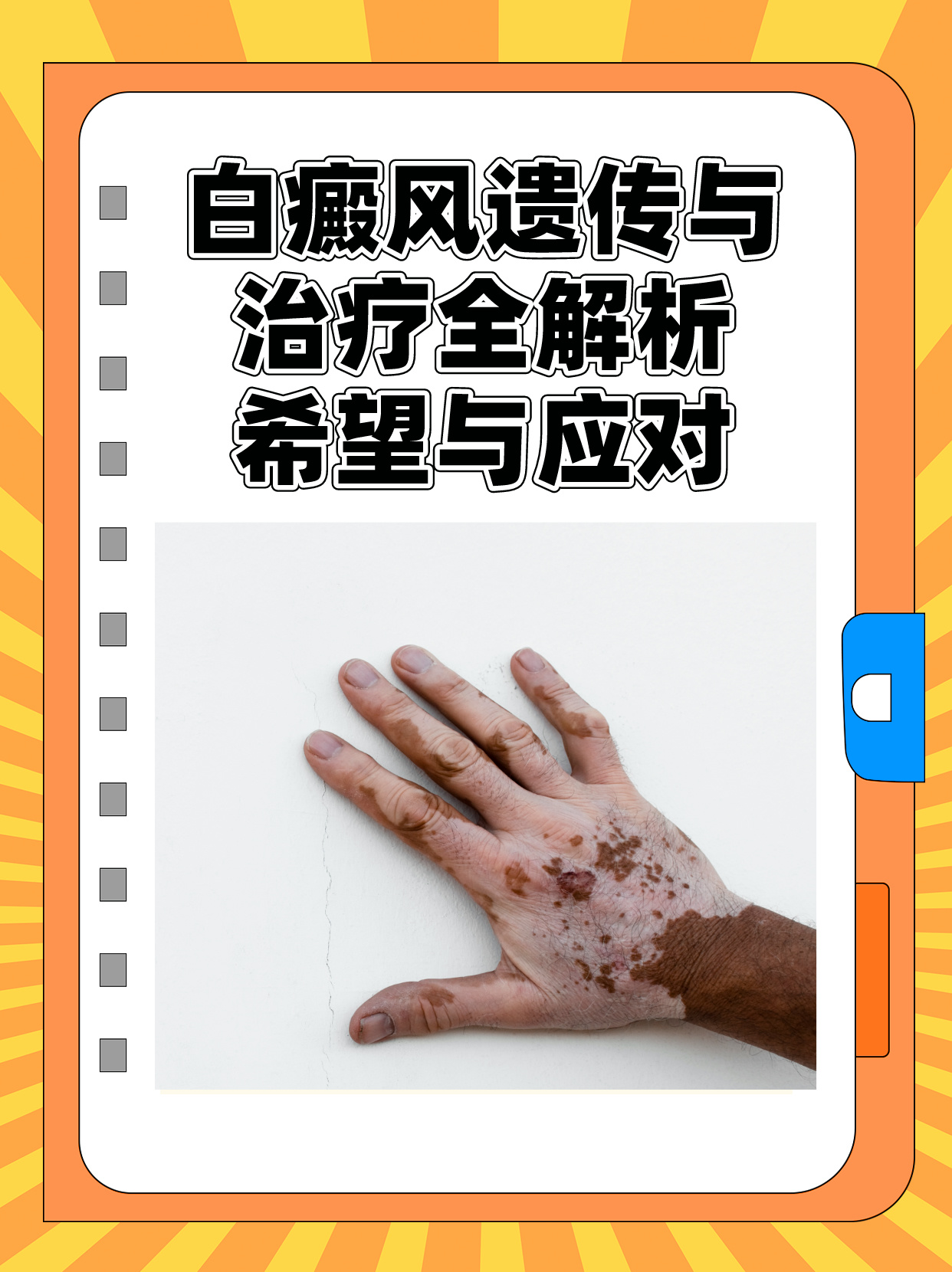 白斑病最新治療技術揭秘