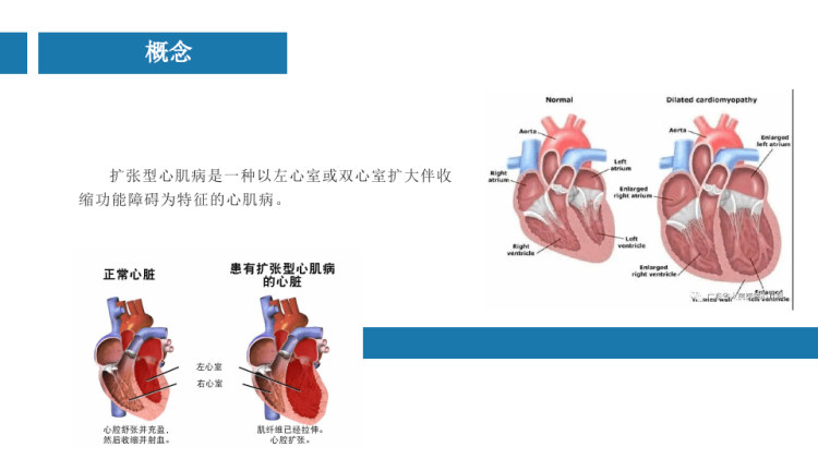 心肌擴(kuò)張中國(guó)最新療法揭秘，創(chuàng)新治療引領(lǐng)未來??